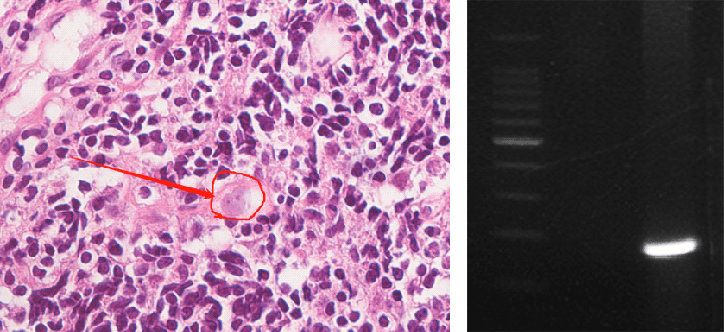 皇冠信用网APP下载_上海确诊1例！张文宏团队参与会诊！病死率极高皇冠信用网APP下载，发病一周内迅速恶化