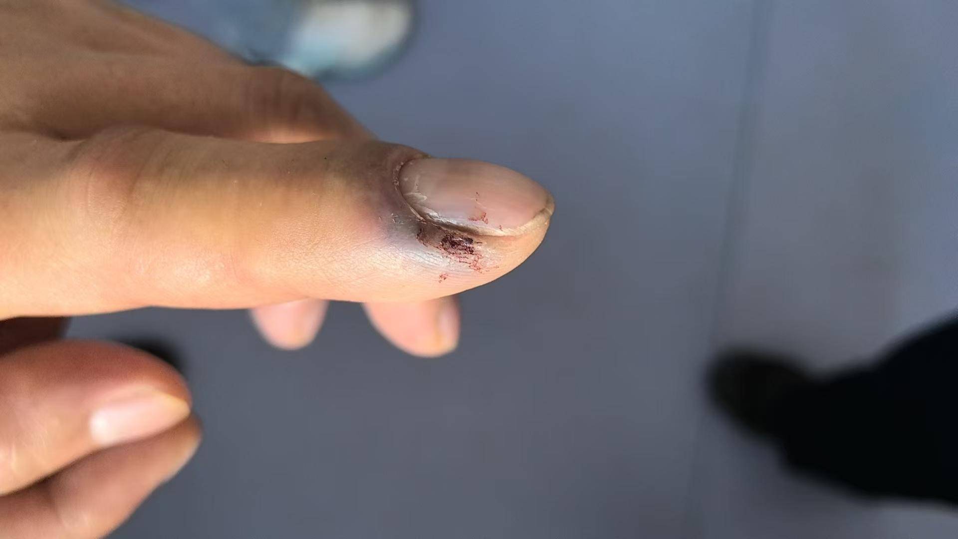 皇冠信用網怎么租_青海一男子被罕见剧毒阿拉善蝮蛇咬伤皇冠信用網怎么租，因无血清一度想放弃治疗 警车开道转运700公里救命