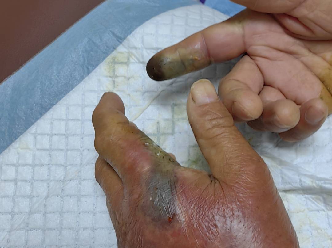 纽约红牛vs哥伦布机员_眼镜王蛇咬伤老人纽约红牛vs哥伦布机员，家属拖两米多长的“凶手”冲进医院！“拎蛇就医”可取吗？