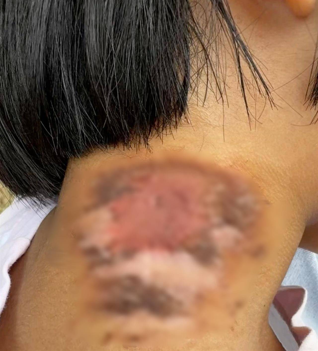 皇冠信用平台出租出售_河南多地现“行走的硫酸”：洛阳一工地脚手架密密麻麻全是皇冠信用平台出租出售，南阳4岁女童沾上它脖子红肿溃烂20余天未痊愈